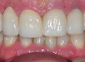 After Treatment